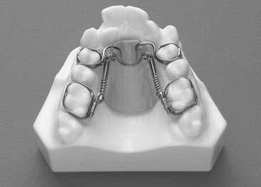 The Inman Power component (IPC) extends through tubes to guide the maxillary first molars during distalization.