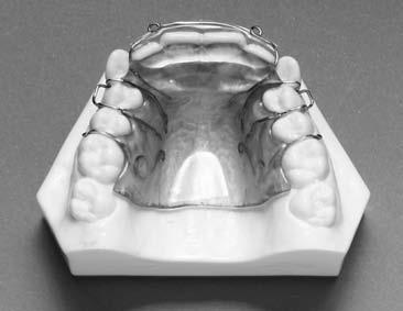 Adams clasps are used for retention on the first bicuspids and on the opposite molar that is being distalized.