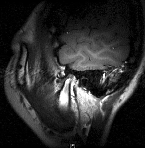 Clinical evaluation of TMJ disorder after orthognathic surgery in skeletal class II malocclusion patients Fig. 7. Changes of magnetic resonance imaging after orthognathic surgery.
