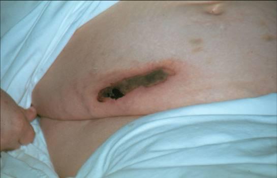 Clinical Presentation Other manifestations Skin lesions Acute systemic reactions Disseminated intravascular coagulation