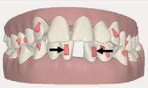 Conventional attachments - default protocols. 1 For certain Invisalign treatments conventional attachments will be placed by default.