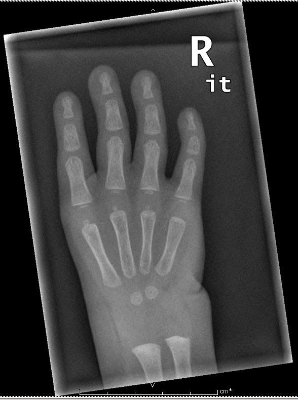 Congenital Hand Anomalies - An Overview Occupational