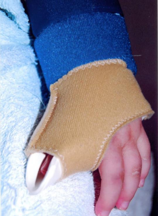 General Splinting for Congenital Hand Anomalies Goals of treatment: Maximise range of motion Maximise functional hand