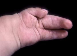 Hypoplastic thumb 2 3 5 Central