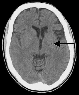 Figure 5: Brain MRI without contrast (axial Flair sequence): Acute or
