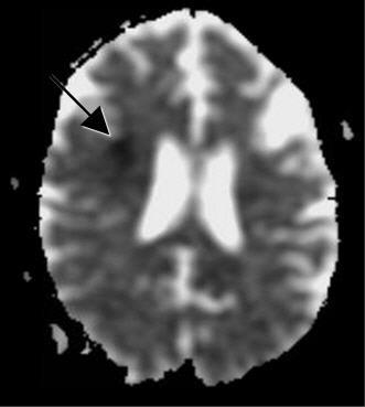 Figure 7: Brain MRI without contrast (ADC map): Showing infarct