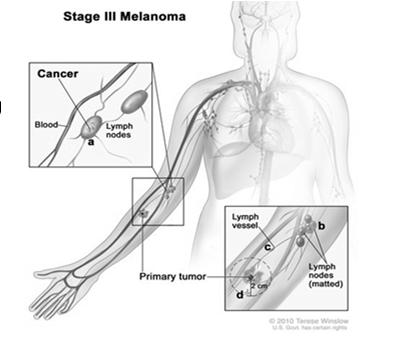 Unknown Primary Site Metastatic melanoma with not apparent primary should be coded to C44.