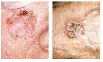 Squamous Cell Carcinoma [SCC] Squamous Cell Carcinoma 2 nd Most Common Skin Cancer Cumulative UV exposure over lifetime Deadly if undiagnosed and untreated ~ 700,000 cases annually ~ 2,500 deaths