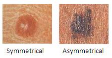 Melanoma Risk Factors: Know Your ABCDE
