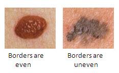 Asymmetry Moles Border irregular Skin