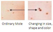 Evolving Four Basic Types of Melanoma 3 Types start in situ localized to the skin s top layers