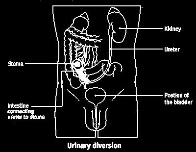 How will I pass urine after the operation? During the operation the surgeon carries out a procedure called a 'urinary diversion'.