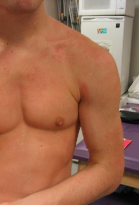 Clavicle Palpation Acromioclavicular