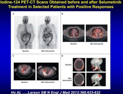 Lu-177 PSMA RN therapy of metastatic castration-resistant prostate cancer
