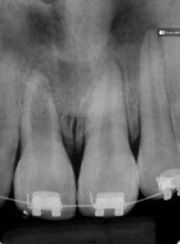 This study aimed to present two clinical cases of revascularization in young permanent teeth with incomplete rhizogenesis, pulp necrosis and fistula. II. Case report Patient J.V.A.R.
