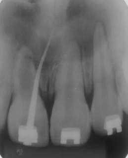 During the anamnesis, the patient reported a trauma to this tooth at the age of seven when he suffered a cycling accident. The patient's mother signed the informed consent form, authorizing treatment.
