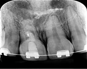 The canal was dried with absorbent paper tips, decreasing 2 mm of the length of the tooth in the radiography, trying to minimize injuries to the cells of the periapical region.