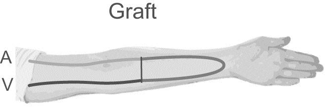 Graft A join is made between an artery and a vein, usually in your arm using either a tube made of an artificial material or from part of one of your own blood vessels.