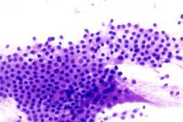 Cytologic Reporting of Follicular Lesions BENIGN Macrofollicles and colloid,
