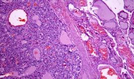 **A sensitive and specific marker to distinguish follicular adenomas from carcinomas has yet to be identified.