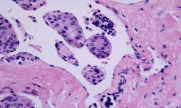 What are the features used to diagnose an FNA as Suspicious for a Hurthle cell neoplasm in the Bethesda System?
