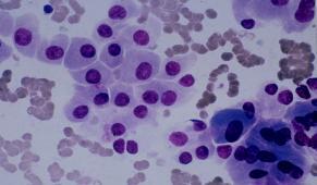 FNA OF HURTHLE CELL NEOPLASMS Both Hurthle cell adenomas and carcinomas are diagnosed by FNA as