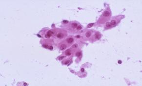 Oncocytic neoplasms in the DDX of