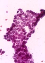 Papillary Thyroid Carcinoma is the Most Common Cause of a Suspicious/Malignant Dx FNA is highly accurate: >90% are diagnosed as positive or suspicious by FNA Papillary Thyroid