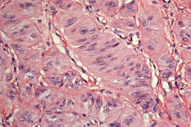 Hyalinizing Trabecular Tumor (Some consider this an indolent variant of PTC) SUMMARY FNA is an essential initial test for evaluating thyroid nodules The