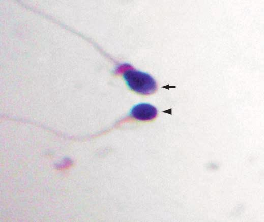 Anatomic Pathology / Original Article A B C D Image 1 Papanicolaou stain showing various morphologic features of sperm. A, Amorphous head with thickened midpiece (arrow); round head (arrowhead).