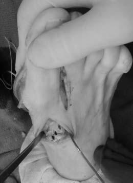 and abductor tendon release.