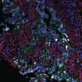 Figure 1 A mouse pancreatic ductal adenocarcinoma showing the FAP+ stromal cells (red) surrounding the ductal cancer cells (green) with Trp53R172H+ nuclei (white). Photograph courtesy of James Jones.