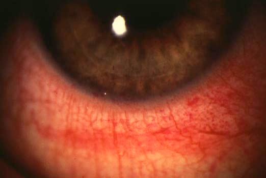 Lagophthalmos Def: incomplete closure of the eyelid SX: FBS, irritation, red, burn, dry, chronic morning corneal irritation Lagophthalmos: signs 2-5 mm lid separation with slit lamp during blink can