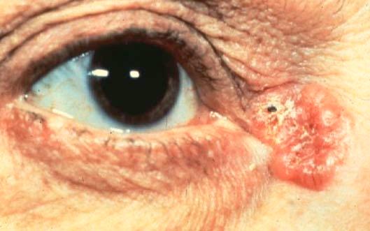Squamous Cell Carcinoma Appearance may be