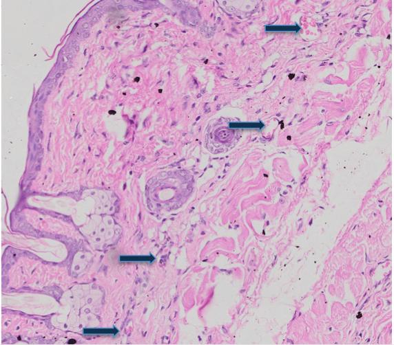 Fig. 2: Histopathology showing the extent of Angiogenesis; Vascularization (arrows); Hematoxylin eosin staining.