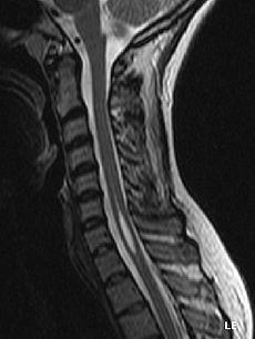 Syringomyelia is a generic term referring to a disorder in which a cyst or cavity forms within the spinal cord.