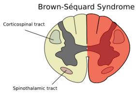 Brown-Séquard syndrome is a loss of sensation and motor function (paralysis and anesthesia) that is caused by the lateral hemisection (cutting) of the spinal cord.