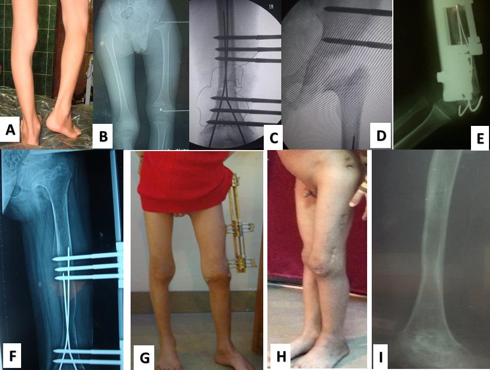 femoral growth, and specific complications have not been reported clearly in literatures.