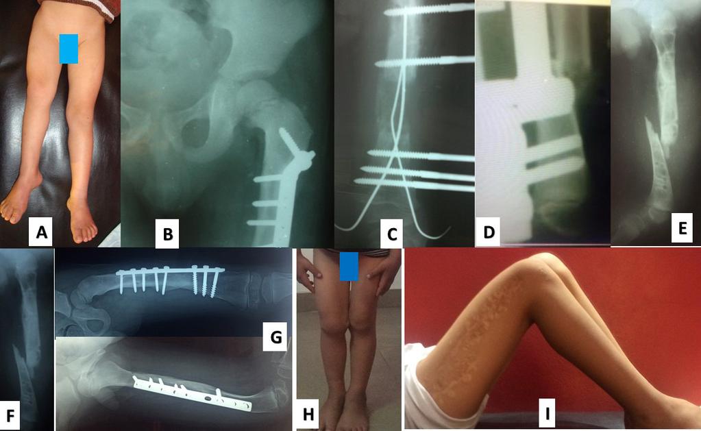 Fig3. Male patient 5 years old with right side congenital short femur A) preoperative photo with short femur; B) x-ray after correction of coxa vara; C) x-ray 6 months postoperative with callus
