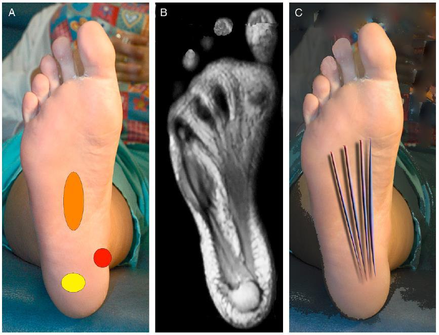 Tenderness tenderness may be localized centrally along the plantar fascia (orange oval), along the
