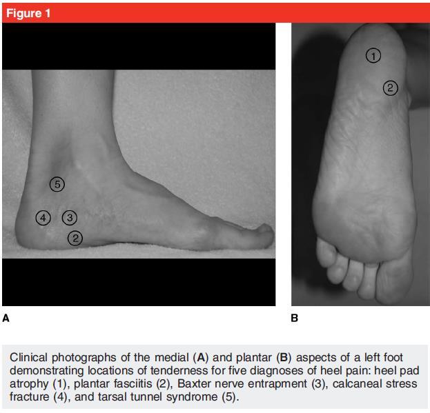 Differential Diagnosis Clinical photographs of the medial (A) and plantar (B) aspects of a left foot demonstrating locations of tenderness for five