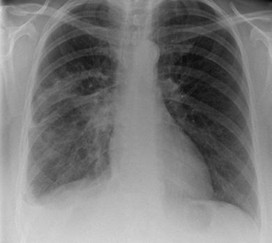Answer 3 c. 40 60% [1]. Following drainage of the pleural effusion via a chest drain, we performed repeat imaging of the chest. This demonstrated complete resolution of the pleural effusion.