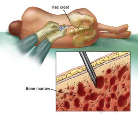 The Bone Marrow Biopsy & Aspirate Bone marrow examination When blood tests indicate the presence of low blood counts (cytopenias), your physician may recommend a bone marrow examination.