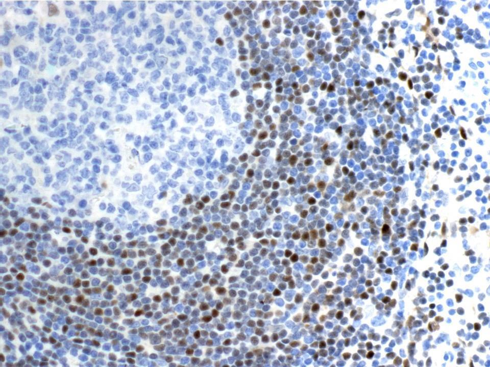 Pathology of the indolent B-cell lymphomas