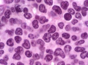 Mantle Cell Lymphoma 1.0 0.