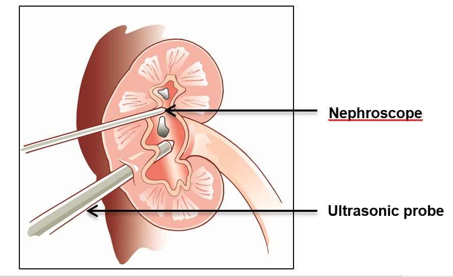 This procedure is preferred for renal stones larger than 2-3 cm in size.