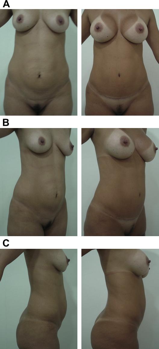 478 Saldanha et al a greater reduction in abdominal measurements, and leads to better body contour. There has been less demand for surgical revision since adopting this technique.