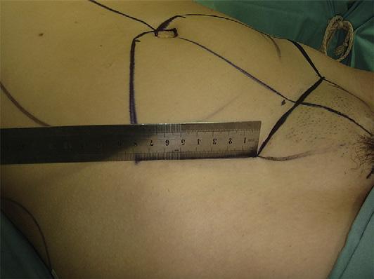 Lipoabdominoplasty: The Saldanha Technique 471 Fig. 4. Oblique marking (8 cm). Fig. 6. Infiltration. flap compared with traditional abdominoplasty.
