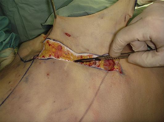 In borderline cases where it is not clear whether the proposed superior extent of resection can be reached, begin with a high suprapubic incision. Do not perform in patients with eventration.