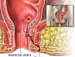Crohn s Disease Any part of GI tract Teens and 20 s Rising incidence Perianal findings Presentation Crohn s Mild to moderate